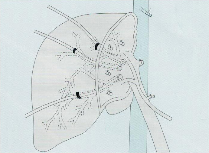逆行性经胆管引流管2